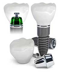 Dental Implants in Racine